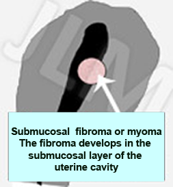 Fibromas or Myomas