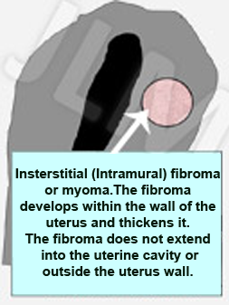 Fibromas or Myomas