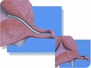 Tubal sterilisation (ligation)