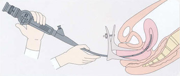 Diagnostic hysteroscopy