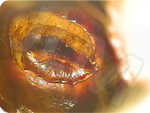 Resection of a cervical lesion